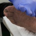 Step-by-Step Guide To the Mechanical Wound Debridement Procedure In Wound Assessment