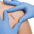 Wound Assessment and the Healing Stages for Surgical Wounds, Scars, and Stitches