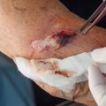 How to Identify the Difference Between Laceration Vs Abrasion During Wound Assessment