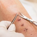 The Best Ways to Monitor Normal Stitches Healing Stages for Faster Recovery