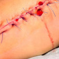 How Long Does It Take for Stitches to Dissolve? Answers for Better Wound Assessment