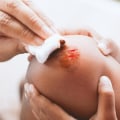 How To Properly Assess And Manage Denuded Skin Wounds