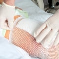 Optimizing Surgical Site Infection Wound Treatment With Proper Assessment Techniques