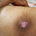 Mastering Wound Assessment Techniques For Stage 4 Pressure Ulcers