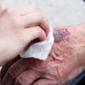 The Importance of Wound Care for Caregivers