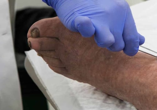 Step-by-Step Guide To the Mechanical Wound Debridement Procedure In Wound Assessment