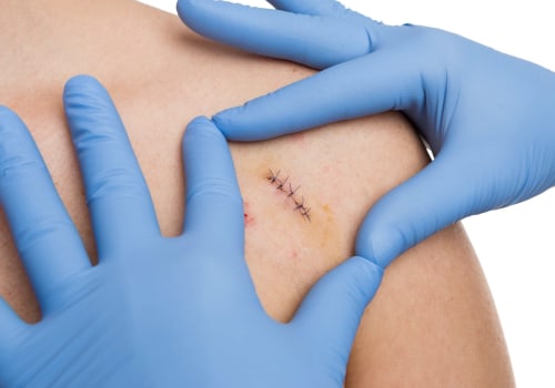 Wound Assessment and the Healing Stages for Surgical Wounds, Scars, and Stitches