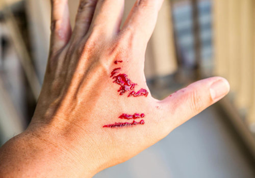 How to Treat a Skin Avulsion Wound With Accurate Assessment and Timely Care