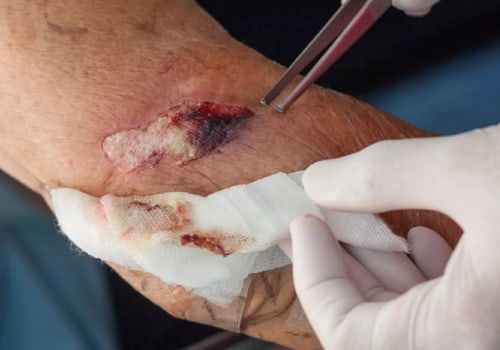 How to Identify the Difference Between Laceration Vs Abrasion During Wound Assessment