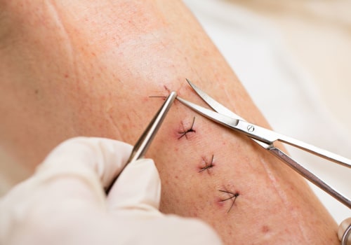 The Best Ways to Monitor Normal Stitches Healing Stages for Faster Recovery