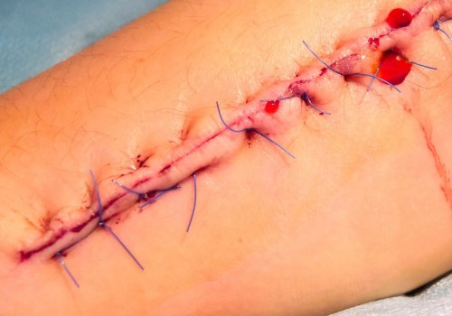 How Long Does It Take for Stitches to Dissolve? Answers for Better Wound Assessment