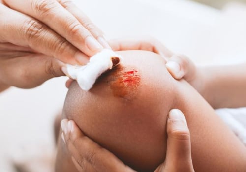 How To Properly Assess And Manage Denuded Skin Wounds